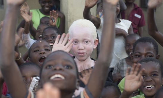 A picture of Annie Alfred at school - taken in Malawi. This photo is part of the Malawi campaign to stop the killings of people with albinism in Malawi.