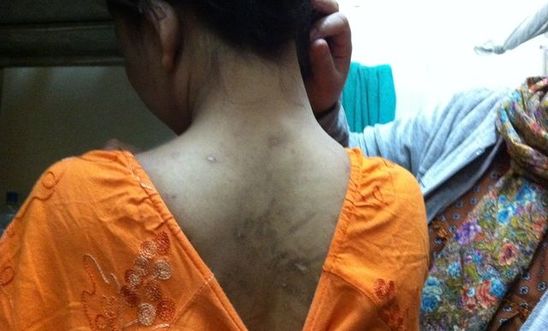 A former domestic worker from Indonesia shows scars on her back