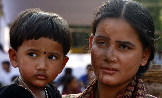 Acid attack survivor with her child in Bangladesh, 2010 Acid attack survivor with her child in Bangladesh, 2010