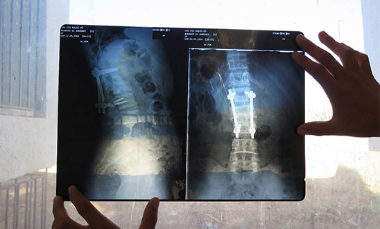 An x-ray showing a student’s fractured vertebrae