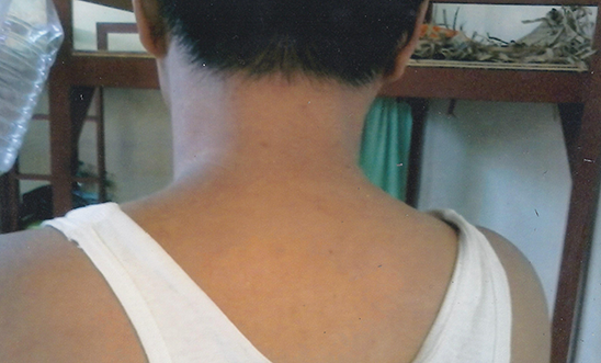 Picture of Alfreda Disbarro's back where he was beaten Picture of Alfreda Disbarro's back where he was beaten