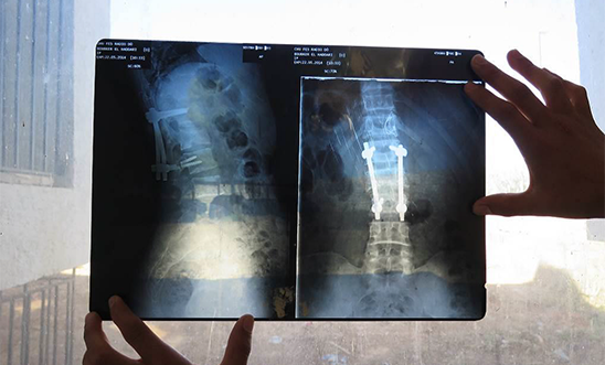 An x-ray showing a student’s fractured vertebrae An x-ray showing a student’s fractured vertebrae