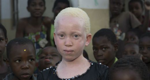 Annie Alfred was born with albinism